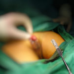 obřízka - operace